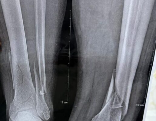 معالجة كسر كاحل متبدّل مع استعادة الاستقرار المفصلي