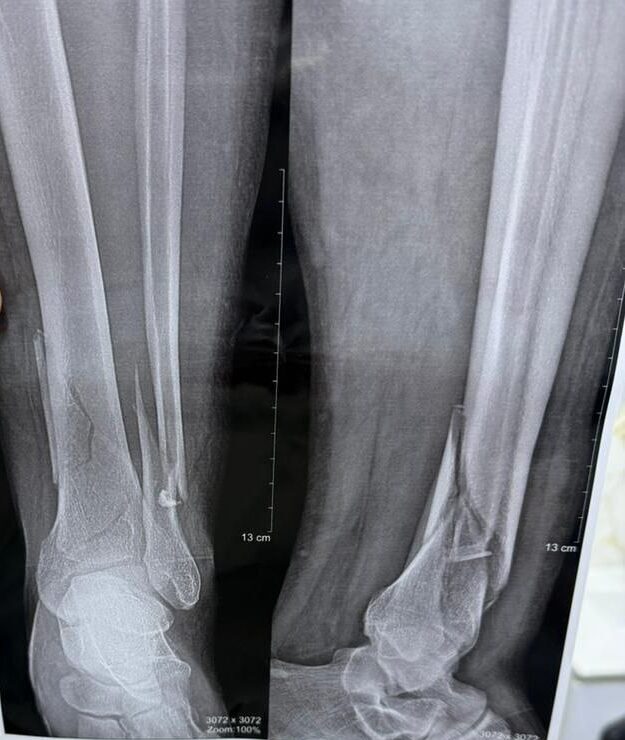 معالجة كسر كاحل متبدّل مع استعادة الاستقرار المفصلي