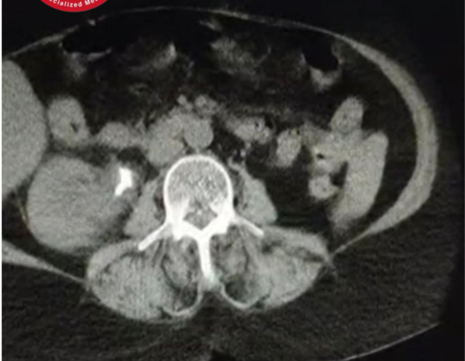 معالجة حالة مرضية لحصاة الوصل الحويضي