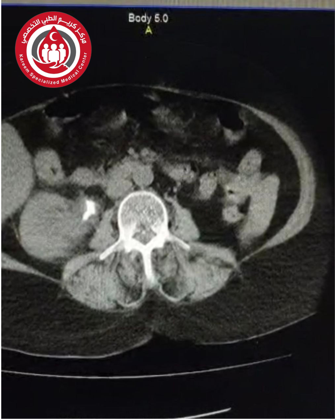 معالجة حالة مرضية لحصاة الوصل الحويضي