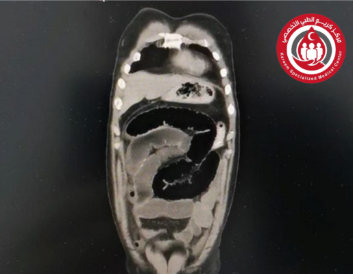 انسداد أمعاء بخراجة زائدة